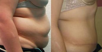 Tummy Tuck Before & After - Dr. Thomassen