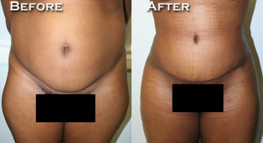 Tummy Tuck Before & After - Dr. Thomassen