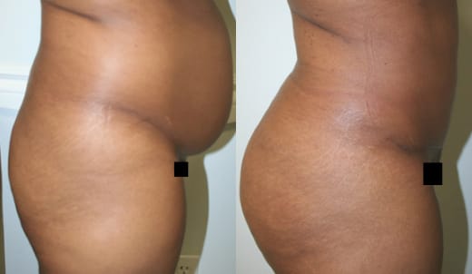 Tummy Tuck Before & After - Dr. Thomassen