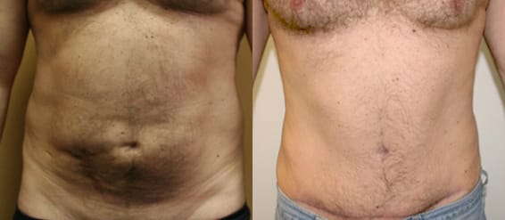 Tummy Tuck Before & After - Dr. Thomassen
