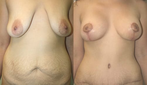 Tummy Tuck Before & After - Dr. Thomassen