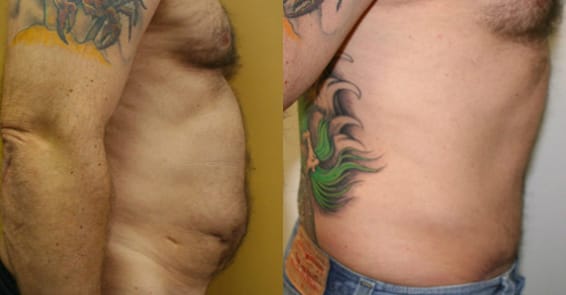 Tummy Tuck Before & After - Dr. Thomassen
