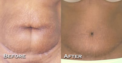 Tummy Tuck Before & After - Dr. Thomassen