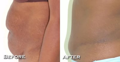 Tummy Tuck Before & After - Dr. Thomassen