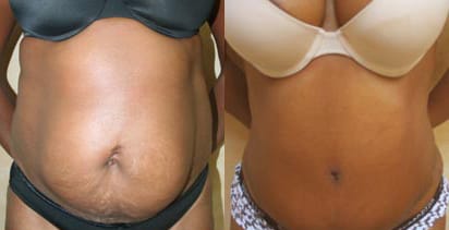 Tummy Tuck Before & After - Dr. Thomassen
