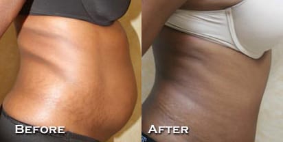 Tummy Tuck Before & After - Dr. Thomassen