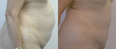 Tummy Tuck Before & After - Dr. Thomassen