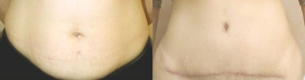Tummy Tuck Before & After - Dr. Thomassen