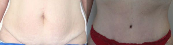 Tummy Tuck Before & After - Dr. Thomassen