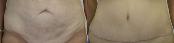 Tummy Tuck Before & After - Dr. Thomassen