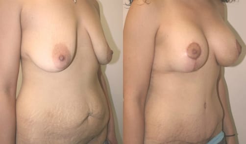 Tummy Tuck Before & After - Dr. Thomassen