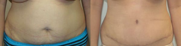 Tummy Tuck Before & After - Dr. Thomassen