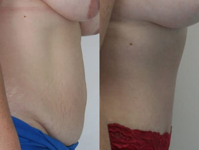 Tummy Tuck Before & After - Dr. Thomassen