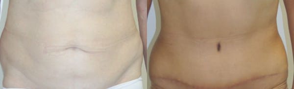 Tummy Tuck Before & After - Dr. Thomassen