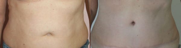 Tummy Tuck Before & After - Dr. Thomassen