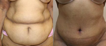 Tummy Tuck Before & After - Dr. Thomassen