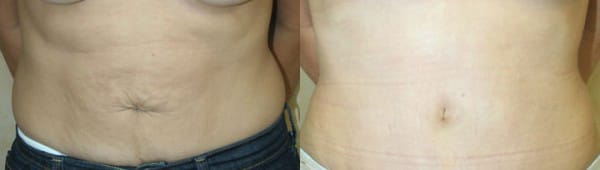 Tummy Tuck Before & After - Dr. Thomassen