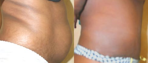 Tummy Tuck Before & After - Dr. Thomassen