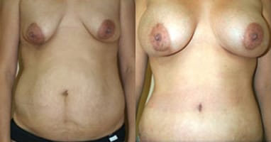 Tummy Tuck Before & After - Dr. Thomassen