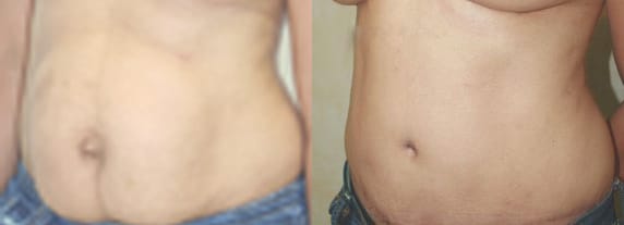 Tummy Tuck Before & After - Dr. Thomassen