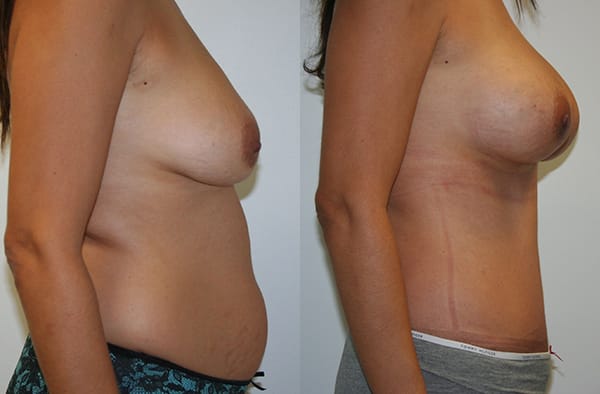 Tummy Tuck Before & After - Dr. Thomassen