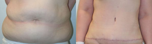 Tummy Tuck Before & After - Dr. Thomassen
