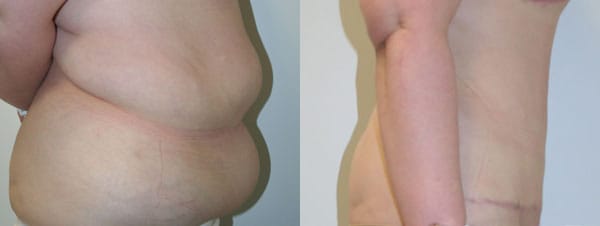 Tummy Tuck Before & After - Dr. Thomassen