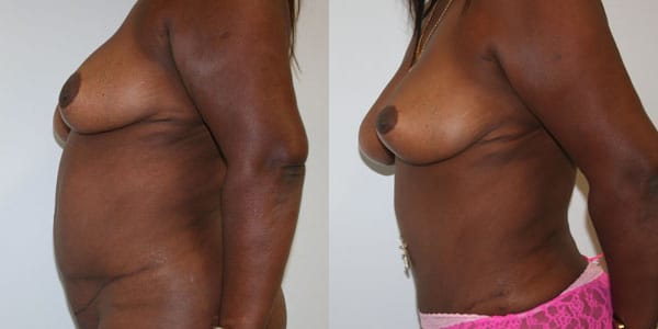 Tummy Tuck Before & After - Dr. Thomassen