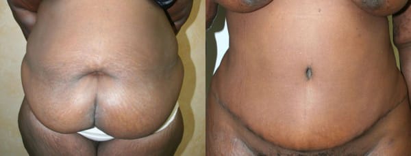 Tummy Tuck Before & After - Dr. Thomassen