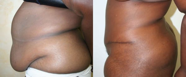 Tummy Tuck Before & After - Dr. Thomassen