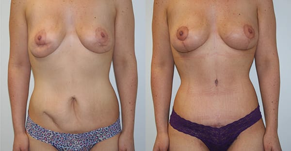 Tummy Tuck Before & After - Dr. Thomassen