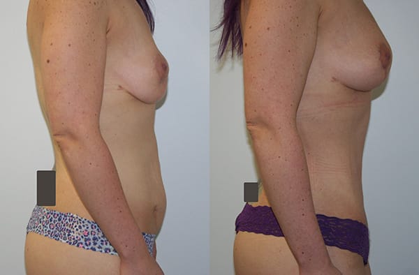 Tummy Tuck Before & After - Dr. Thomassen