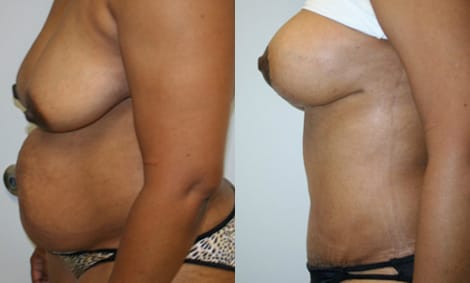 Tummy Tuck Before & After - Dr. Thomassen