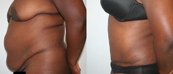 Tummy Tuck Before & After - Dr. Thomassen