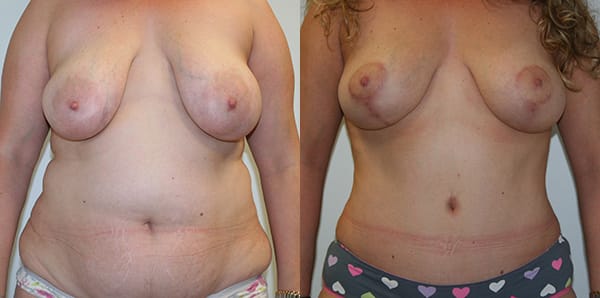 Tummy Tuck Before & After - Dr. Thomassen