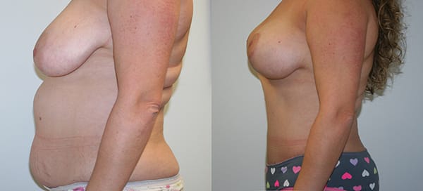 Tummy Tuck Before & After - Dr. Thomassen