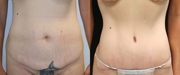 Tummy Tuck Before & After - Dr. Thomassen