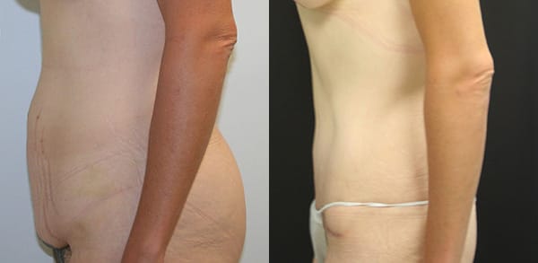 Tummy Tuck Before & After - Dr. Thomassen