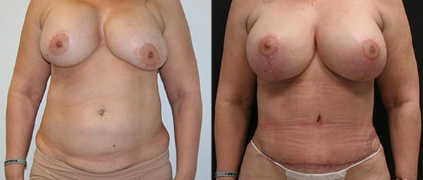 Tummy Tuck Before & After - Dr. Thomassen