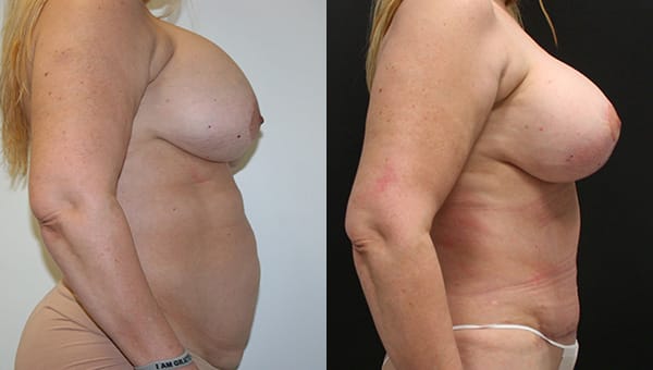 Tummy Tuck Before & After - Dr. Thomassen