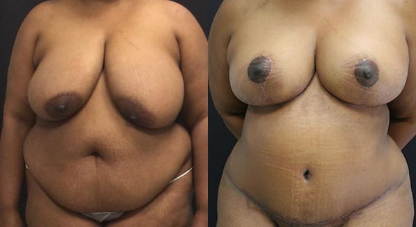Tummy Tuck Before & After - Dr. Thomassen