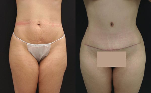 Tummy Tuck Before & After - Dr. Thomassen