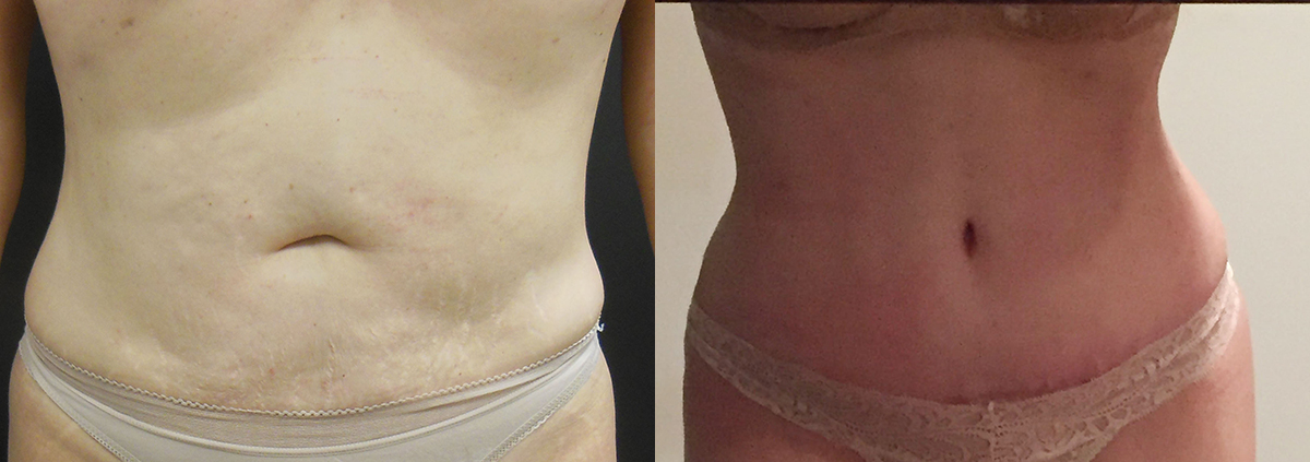 Tummy Tuck Before & After - Dr. Thomassen