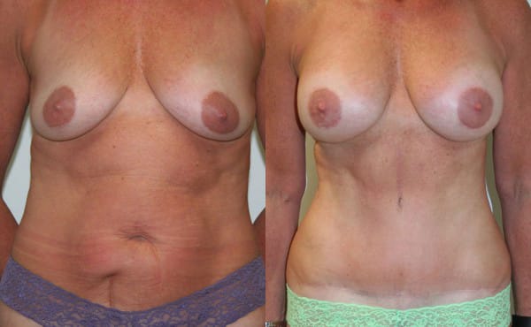 Tummy Tuck Before & After - Dr. Thomassen