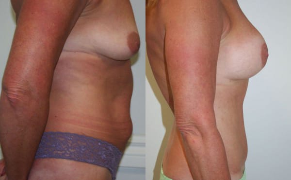 Tummy Tuck Before & After - Dr. Thomassen
