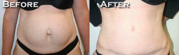 Tummy Tuck Before & After - Dr. Thomassen