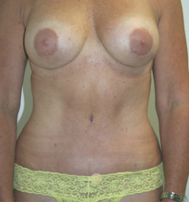 Breast Augmentation
