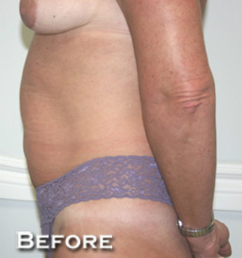 Breast Augmentation