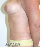 Breast Augmentation