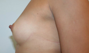 Breast Augmentation